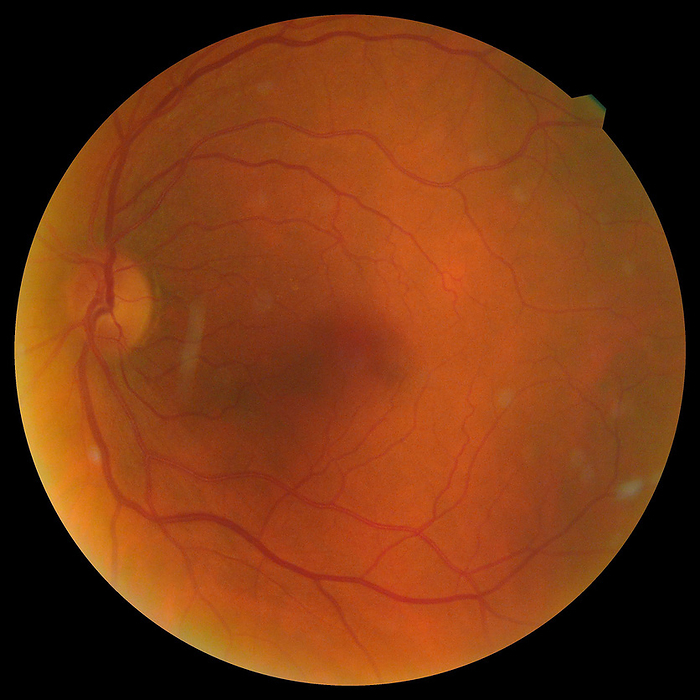 Healthy eye, funduscopy scan Fundoscopy scan of a healthy eye in a 63 year old female patient. The fundus is the inside, back surface of the eye. It is made up of the retina, macula, optic disc, fovea and retinal blood vessels. In a normal fundus, the disc has sharp margins and is normal in colour, with a small central cup. Arterioles and venules also have normal colour. For a scan of the other eye of this patient, see SPL code C059 5564., by DR P. MARAZZI SCIENCE PHOTO LIBRARY