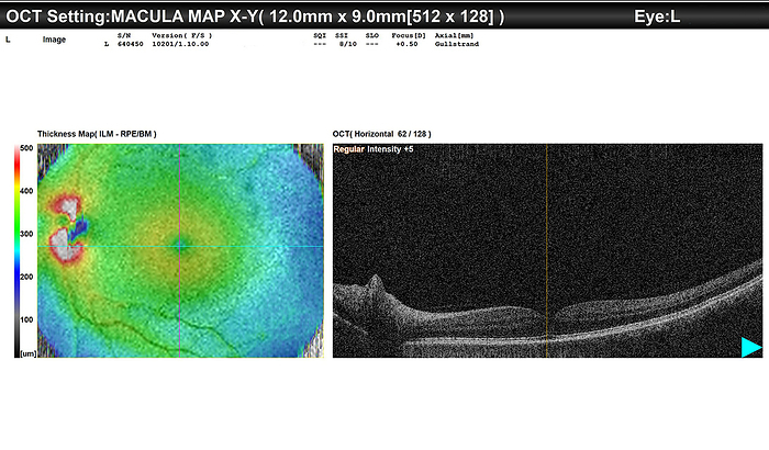 Healthy eye, OCT scan Optical coherence tomography  OCT  scan  right  and retinal thickness map  left  of a healthy left eye in a 63 year old female patient. The warmer colours are indicative of increased retinal thickness, while cooler colours represent thinner areas. The normal OCT scan shows layers of the retina, alternating in light and dark bands. For scans of the right eye of this patient see SPL code C059 5579., by DR P. MARAZZI SCIENCE PHOTO LIBRARY