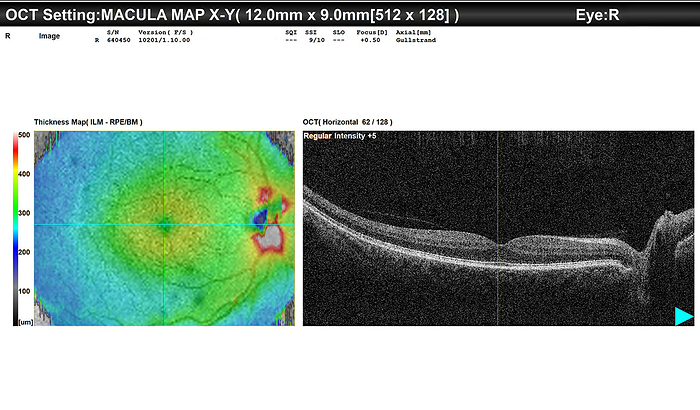 Healthy eye, OCT scan Optical coherence tomography  OCT  scan  right  and retinal thickness map  left  of a healthy right eye in a 63 year old female patient. The warmer colours are indicative of increased retinal thickness, while cooler colours represent thinner areas. The normal OCT scan shows layers of the retina, alternating in light and dark bands. For scans of the right eye of this patient see SPL code C059 5577., by DR P. MARAZZI SCIENCE PHOTO LIBRARY