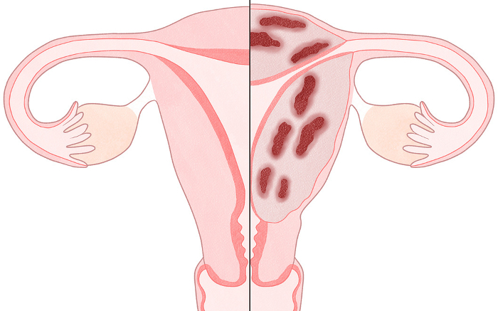 Comparison of fibromyosis and normal uterus Easy-to-understand illustrations