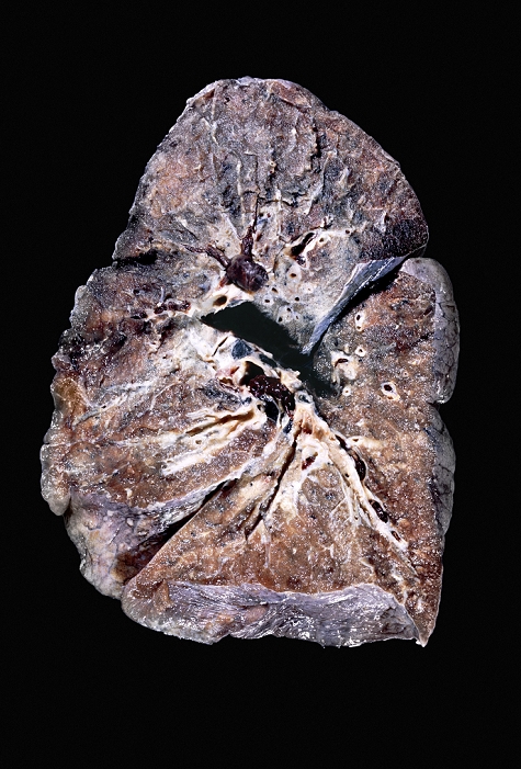 lung cancer Lung cancer. Section through a gross specimen showing malignant  cancerous  tumours in the bronchial  airway  system of a lung. Blood clots  dark red  are also seen in the pulmonary blood vessels. The main cause of lung cancer is cigarette smoke.