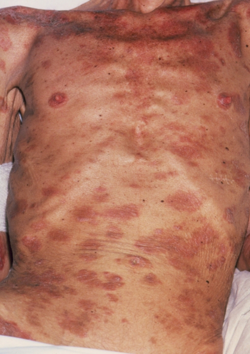 AIDS patient  Date of photograph unknown  Photograph of a person suffering from AIDS  Acquired Immune Deficiency Syndrome , showing marked emaciation accompanied by extensive seborrhoeic dermatitis   the darker patches on the skin. Weight loss due to muscle wastage is evident in some persons with AIDS. Seborrhoeic dermatitis occurs throughout the general population and is therefore not indicative of infection with the AIDS virus  HIV   Human Immunodeficiency Virus . However, the appearance of extensive seborrhoeic dermatitis in a seropositive patient  HIV antibody positive  may be taken as a clinical indication of the development of full blown AIDS.