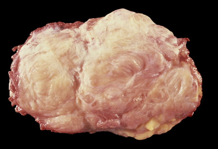 Desmoid Fibroma  Date taken unknown  Desmoid fibroma. Desmoid fibroma in connective tissue removed from a patient. Fibromas are benign  non cancerous  tumours composed of fibrous or connective tissue.