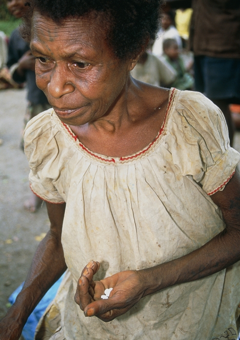 Treatment of elephantiasis Use of ivermectin, etc.  Date of photograph unknown  Woman holding elephantiasis  lymphatic filariasis  drugs in her hand. Elephantiasis is a type of filariasis, a disease caused by parasitic worms spread by blood sucking insects. The worms block the lymphatic system causing fluid accumulation  oedema  and associated swelling of the lymph vessels. Repeated infections result in massive enlargement of the affected part of the body, which is commonly the limbs. The pills of diethylcarbamazine and ivermectin are part of a trial to discover the effectiveness of this drug combination at killing the worms. Photographed in Papua New Guinea.