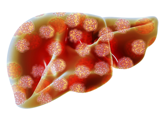 Human liver with hepatitis viruses, Computer artwork of a human liver overlaid with hepatitis B viruses. HBV is transmitted through shared bodily fluids, either sexually or by sharing hypodermic needles. It can also be transmitted from a mother to her baby at childbirth. The virus targets the liver and infection causes loss of appetite, nausea, vomiting, fever and jaundice (yellowing of the eyes and skin).