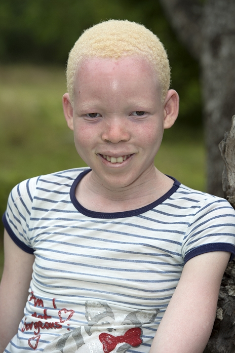 Albino child  Date of photograph unknown  A young Albino Kosi girl. Albinism results in a lack of pigmentation in the eyes, skin and hair. It leads to numerous problems with sensitivity to light in the eyes and skin. The gene causing this condition prevents the body from making the usual amounts of a pigment called melanin. Photographed in Kosi Bay, Kwa Zulu Natal, South Africa.