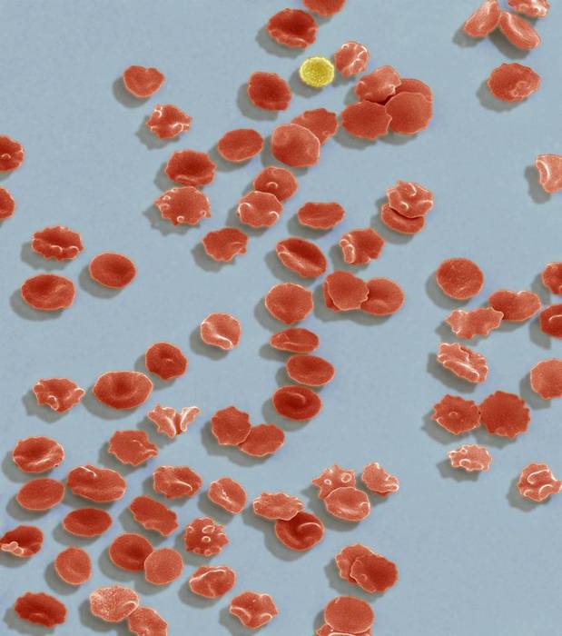 red blood cell Blood cells, coloured scanning electron micrograph  SEM . Seen here are slightly crenated  wrinkled  red blood cells  erythrocytes  and a single white blood cell  yellow . The main function of red blood cells is to distribute oxygen to body tissues, and to carry waste carbon dioxide back to the lungs. White blood cells are part of the immune system  they destroy and remove old or aberrant cells and cellular debris, as well as attack infectious agents  pathogens  and foreign substances. Magnification: x1000 when printed at 10 centimetres high.
