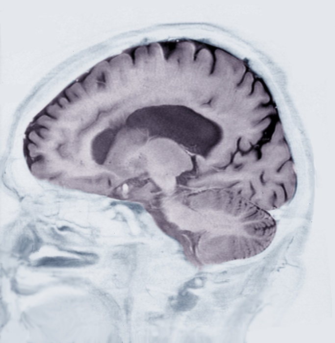 Alzheimer s disease, MRI brain scan Alzheimer s disease. Sagittal magnetic resonance imaging  MRI  scan of the brain of a patient aged over 60 with Alzheimer s disease. The front of the brain is at left. This scan  from the left cerebral hemisphere  is part of a series of scans from the left to the right cerebral hemispheres, showing the cerebral atrophy that has occurred. Alzheimer s is a neurodegenerative disease and a common cause of dementia in the elderly. It is caused by the formation of protein plaques in the brain, which kill surrounding neurons. The cause of these plaques is not known and there is no cure. For the full set of scans, see images C038 8632 to C038 8651.
