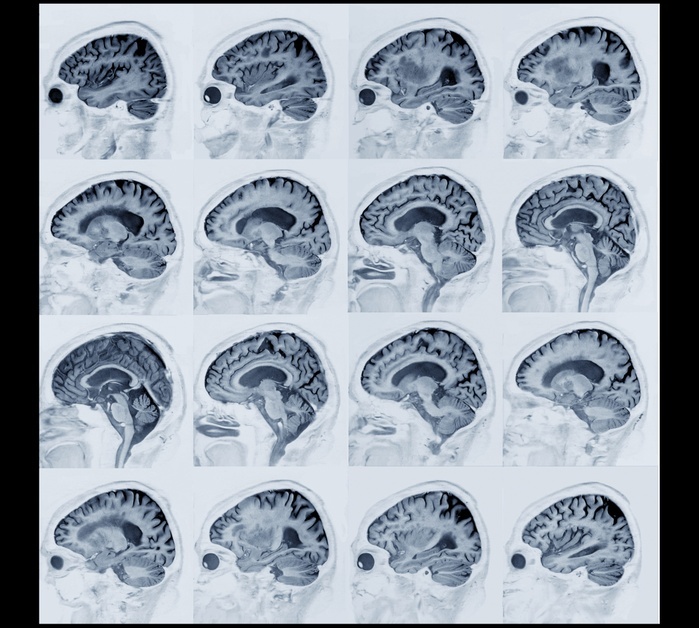 Alzheimer s disease, MRI brain scans Alzheimer s disease. Array of sagittal magnetic resonance imaging  MRI  scans of the brain of a patient aged over 60 with Alzheimer s disease. The front of the brain is at left in each scan. These scans form a series from the left  top left  to the right  bottom right  cerebral hemispheres, showing the cerebral atrophy that has occurred. Alzheimer s is a neurodegenerative disease and a common cause of dementia in the elderly. It is caused by the formation of protein plaques in the brain, which kill surrounding neurons. The cause of these plaques is not known and there is no cure. For the full set of scans, see images C038 8632 to C038 8651.