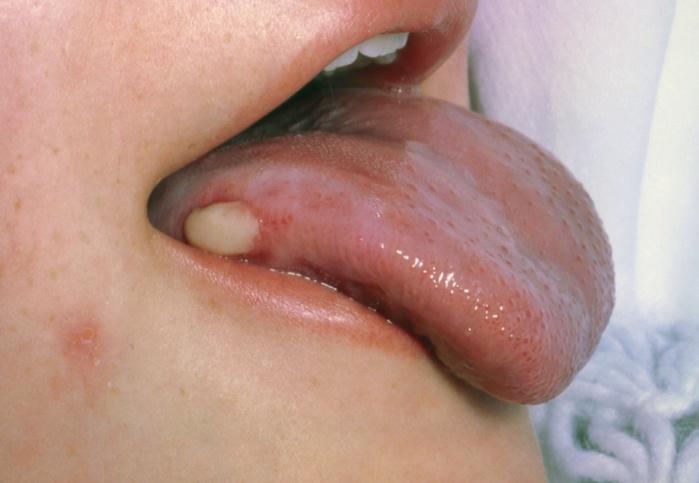 Close up of cancer of the tongue Tongue cancer. Close up of a patient s mouth showing a malignant tumour on the surface edge of the outstretched tongue. Cancer of the tongue is the most serious type of mouth cancer because it spreads rapidly. As here, the edge of the tongue is most commonly affected. An ulcer with raised edges, or a white patch of thickened tissue  leucoplakia  may be the first sign. Usually it is painless until the cancer is advanced. It can spread to gums, the lower jaw, lymph nodes, floor of the mouth and the neck. Treatment may include radiotherapy, cancer drugs and surgery, although survival from advanced tongue cancer is low.